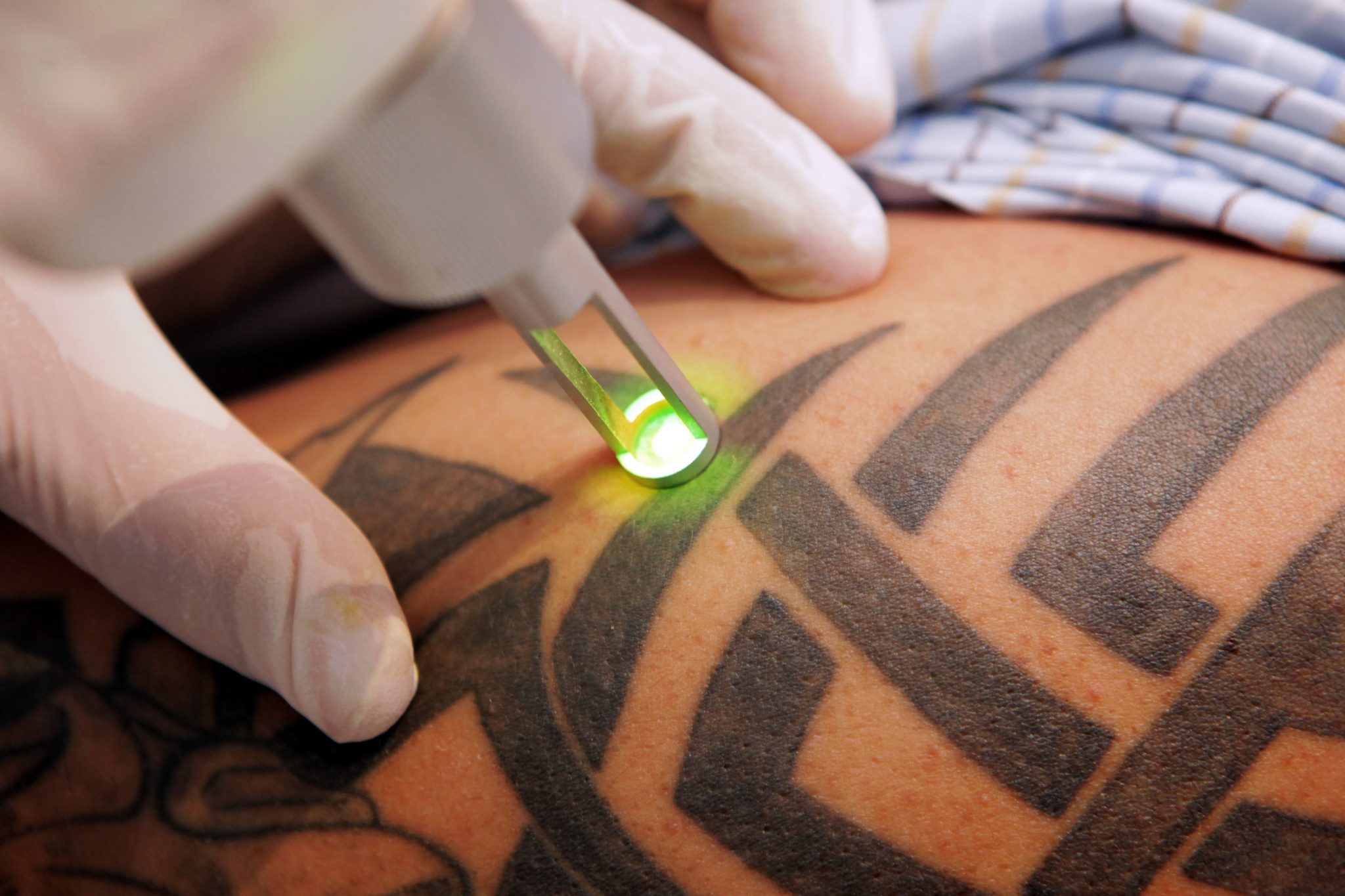 Remoção de Tatuagens com Etherea MX Goiânia Dra. Paula Azevedo Dermatologista